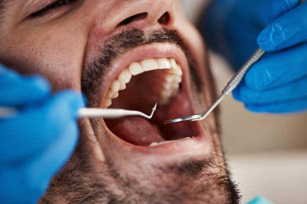 Best Emergency Dentist for Lost Fillings or Crowns in Baxley, GA
